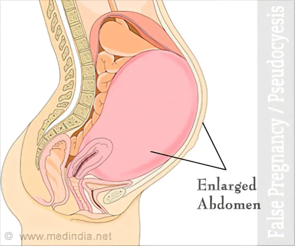 Symptoms of false pregnancy in women. For what reasons there is a false pregnancy