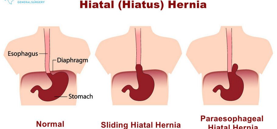Nā ʻōuli o hiatus hernia