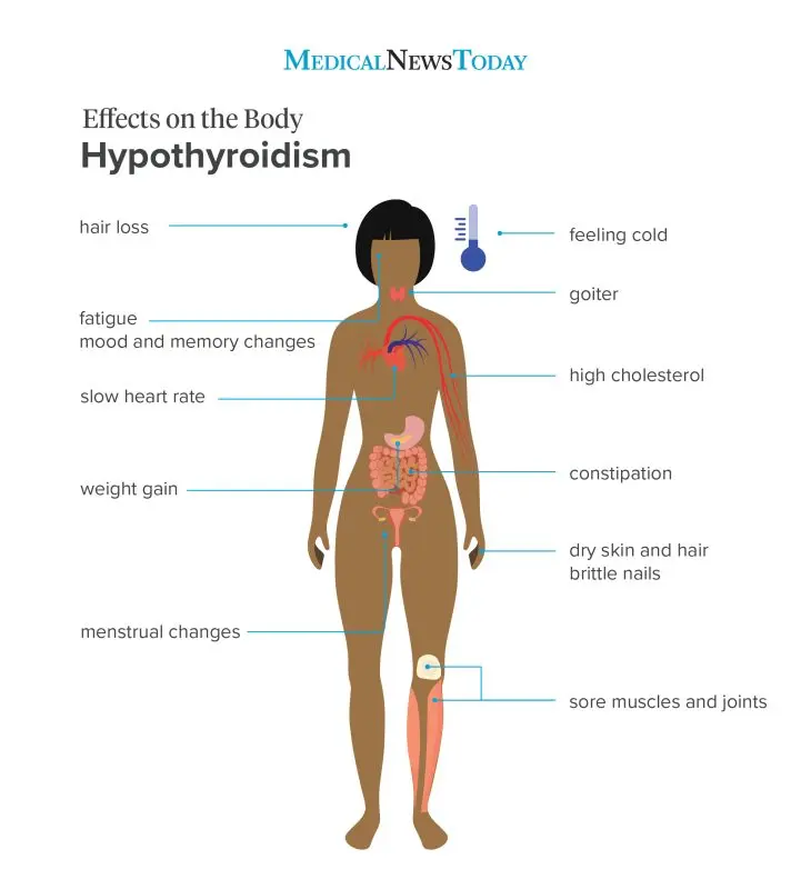 Hypothyroidism &#8211; Sites of Interest