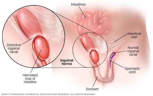 Los síntomas de la hernia inguinal
