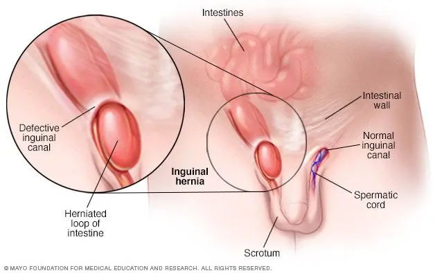 Symptoms of inguinal hernia