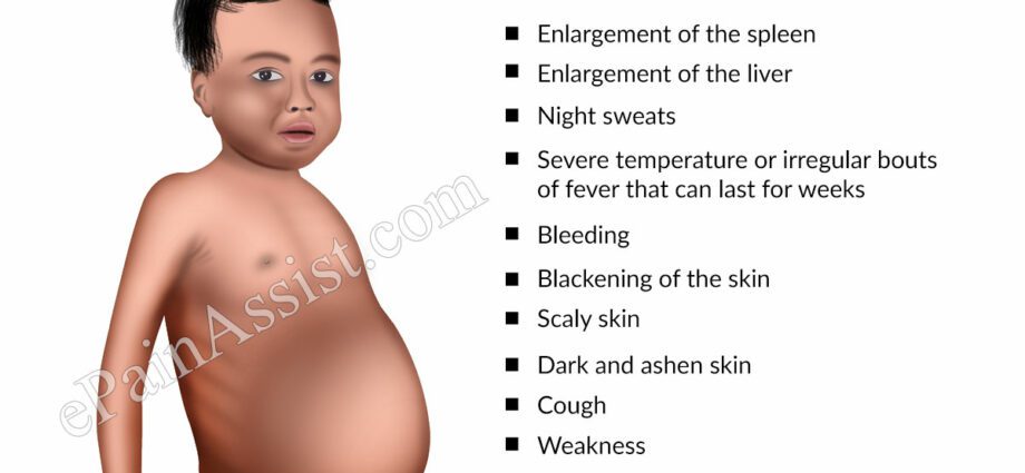 Symptômes de la leishmaniose