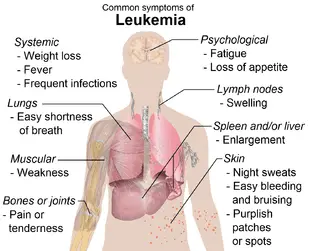 Symptoms of leukemia, people at risk and risk factors