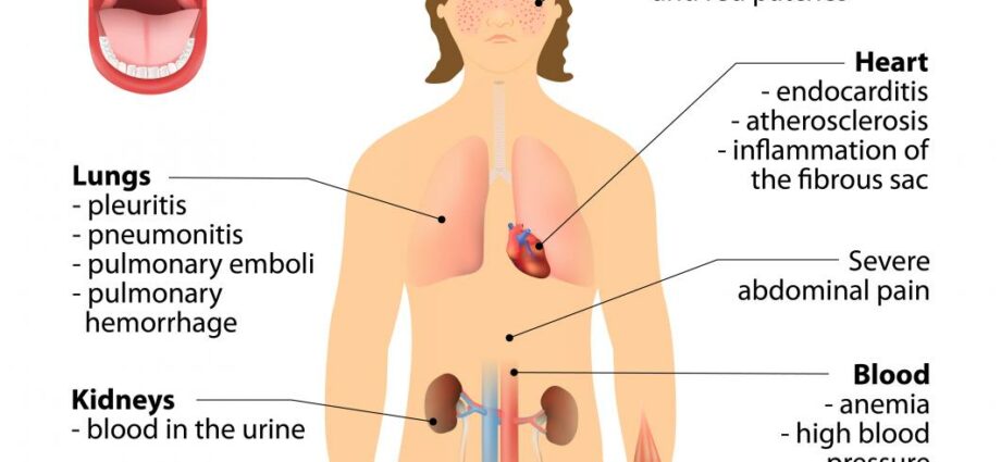 Symptoms of lupus