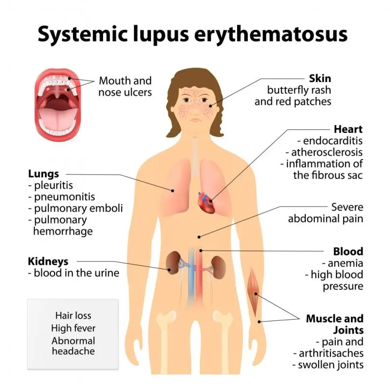 Symptoms of lupus