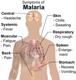 Simptomi malarije (malarije)