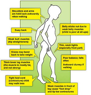 Symptoms of muscular dystrophies – Healthy Food Near Me