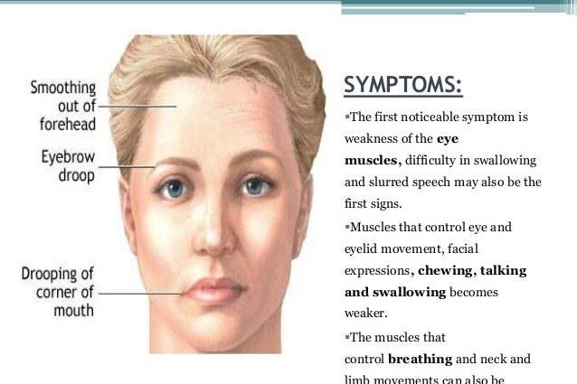 Symptome von Myasthenia gravis