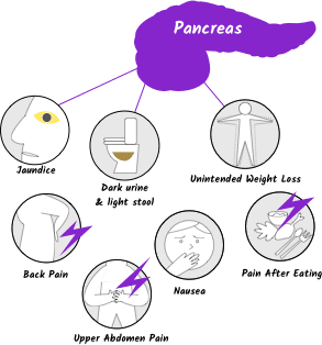 Symptoms of pancreatic cancer