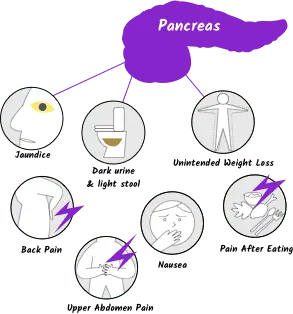 Symptoms of pancreatic cancer