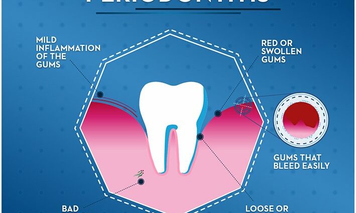 Symptoms of periodontitis