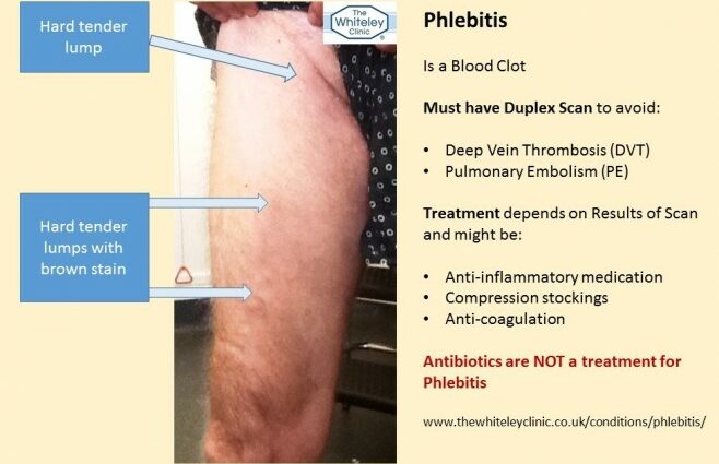 Symptoms of phlebitis (blood clot)