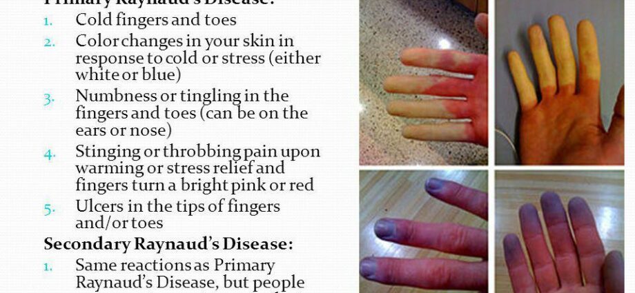 Raynaud&#8217;s disease &#8211; People at risk and risk factors