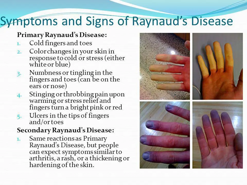 Symptoms of Raynaud&#8217;s disease