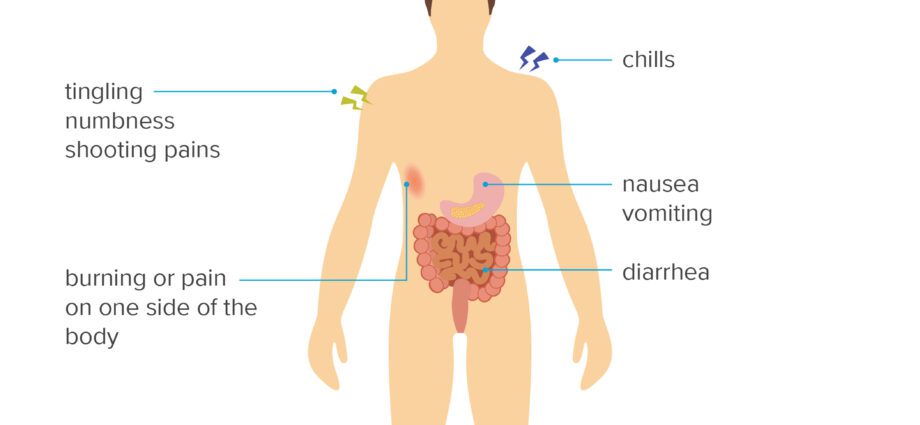 Símptomes de l'herpes zòster