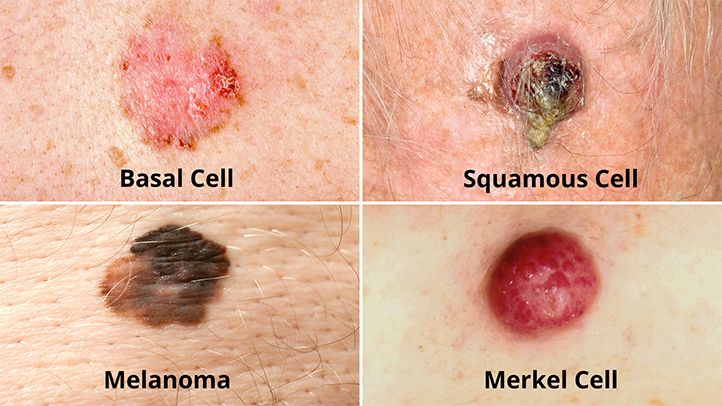 Симптоми раку шкіри