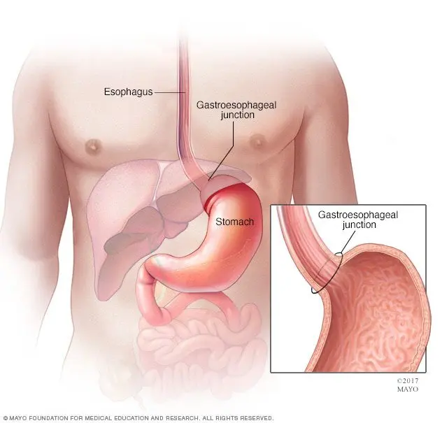 Symptoms of stomach cancer