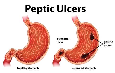 Cov tsos mob ntawm lub plab thiab duodenal ulcer (peptic ulcer)