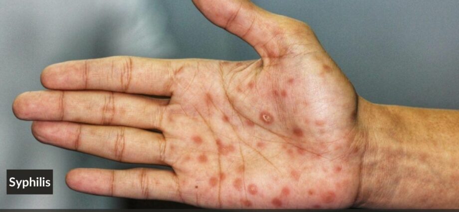Simptomi sifilisa