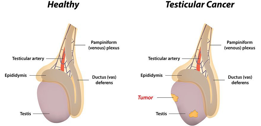 Mga simtomas ng testicular cancer