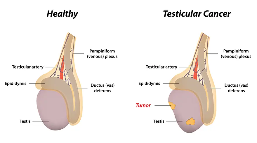 Symptoms of testicular cancer