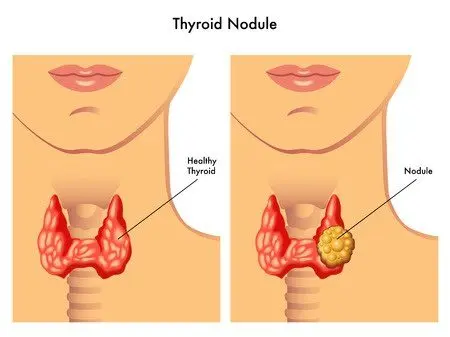 Symptoms of thyroid nodule