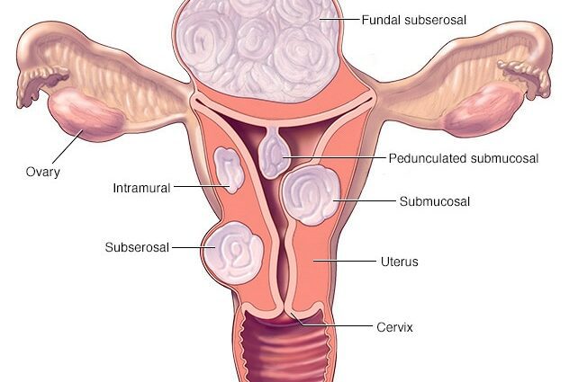 uterine fibroma جي علامات