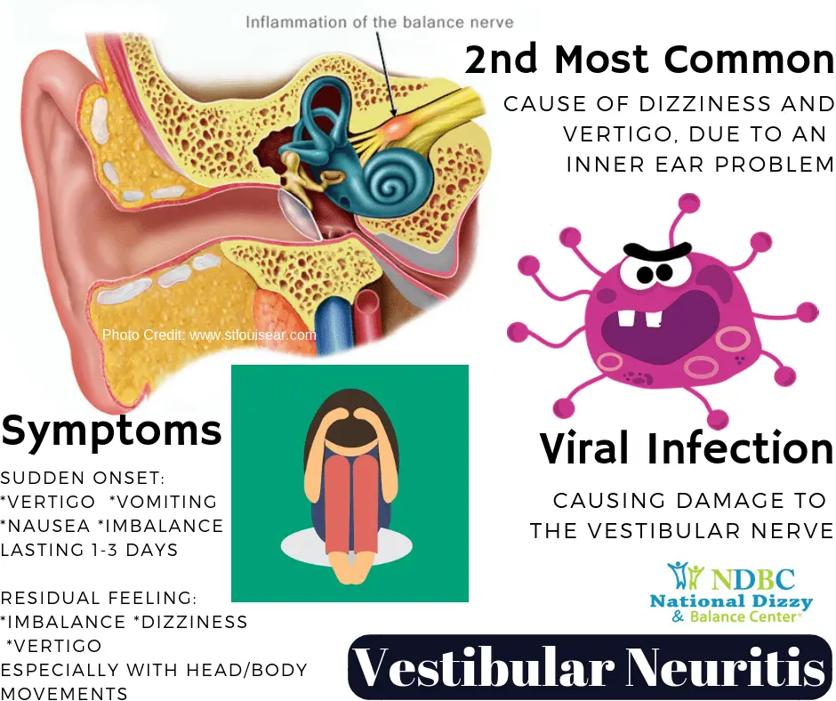 Symptoms of vestibular neuronitis