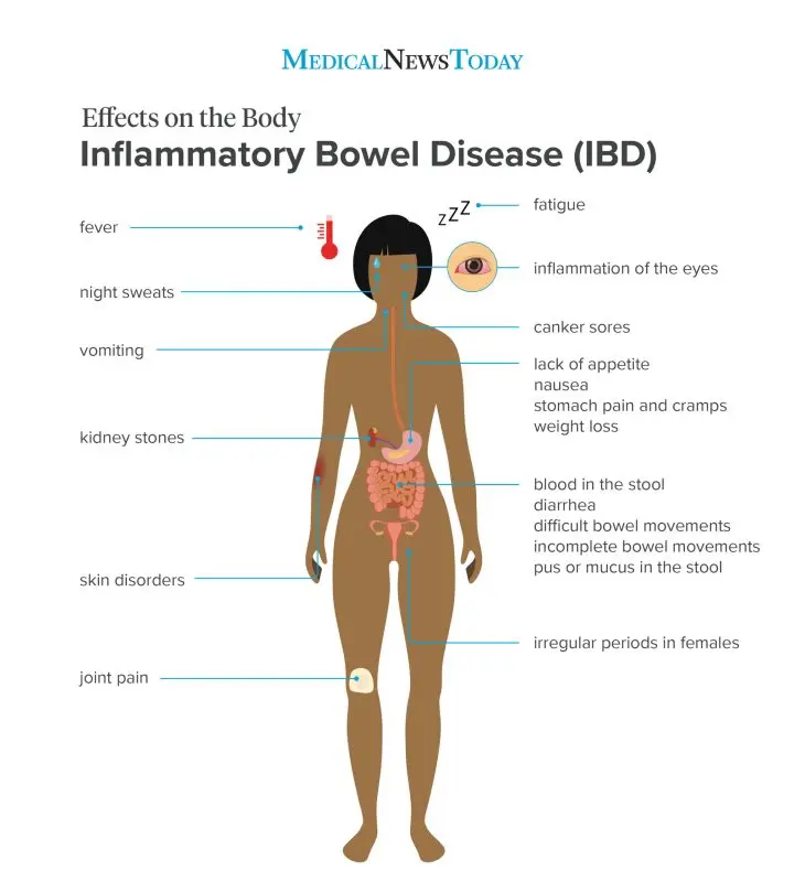 Symptoms, people and risk factors for ulcerative colitis (ulcerative colitis)