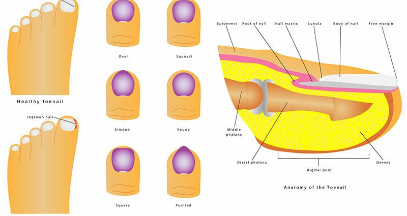 Symptoms, people and risk factors of ingrown toenails