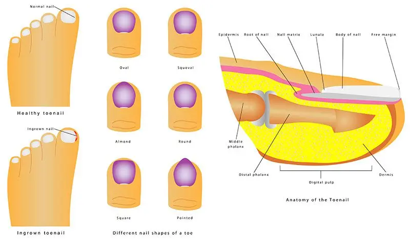 Symptoms, people and risk factors of ingrown toenails