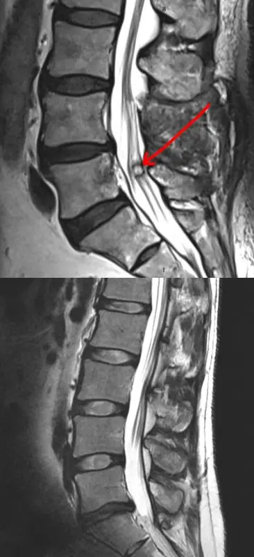 Synovial cyst