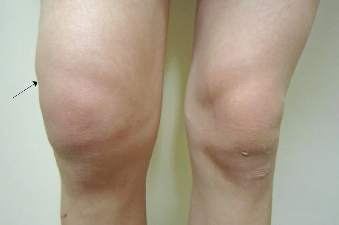 Synovial effusion: what to do if there is synovial fluid in the knee?