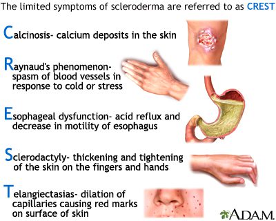 Systemic scleroderma: definition, treatment