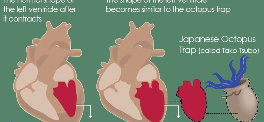 Tako-tsubo: all about broken heart syndrome