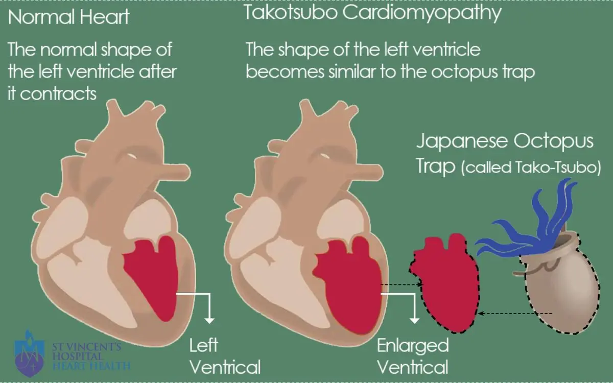 Tako-tsubo: all about broken heart syndrome