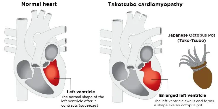 Tako Tsubo syndrome or broken heart syndrome