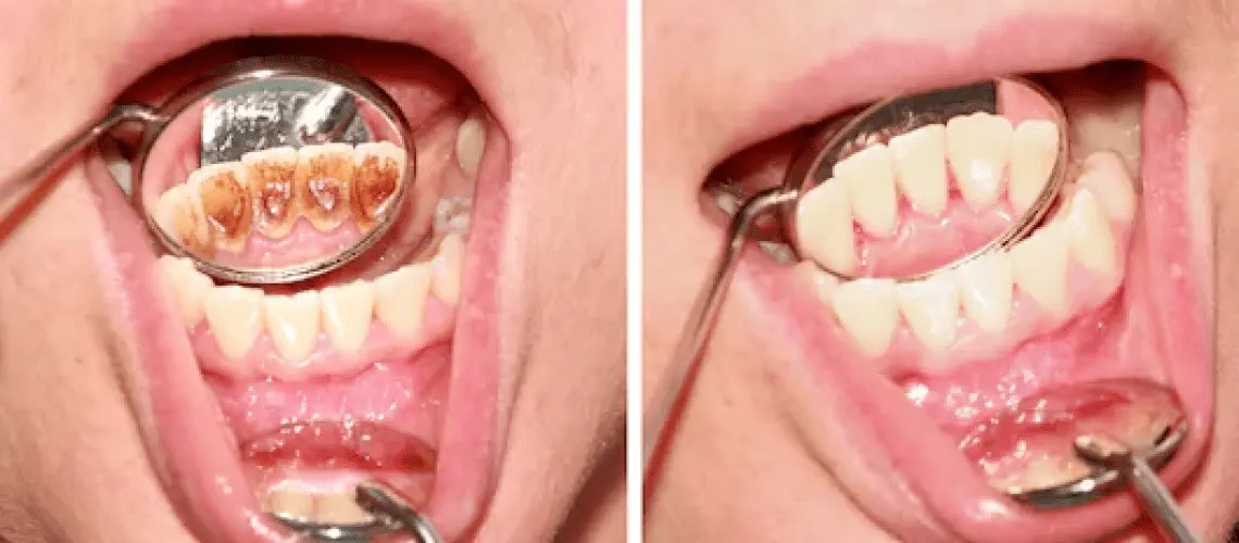 Tartar: how to clean your teeth at home? Video