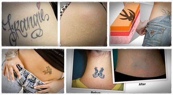 Удаление татуировки: способы удаления татуировки
