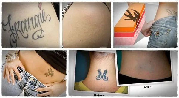 Tattoo removal: methods to remove a tattoo