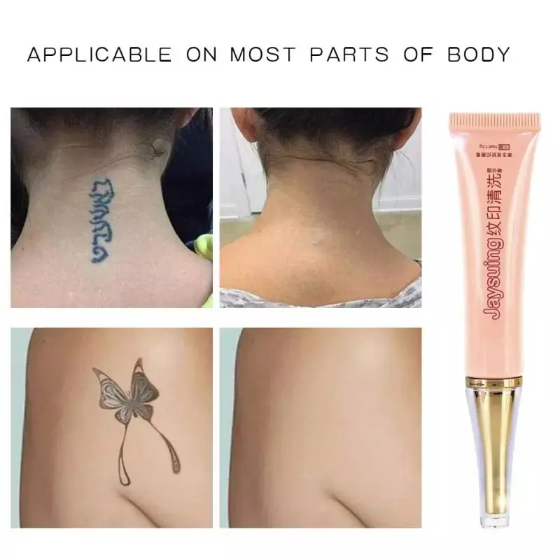 Tattoo removal with cream