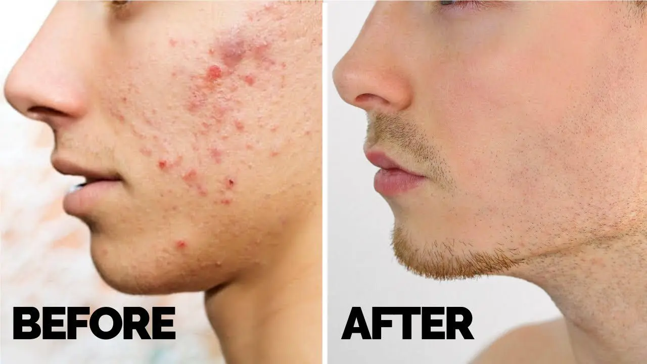 Teenage Acne: How To Eliminate Fast? Video