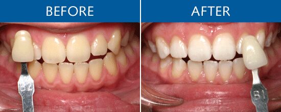 Teeth whiteness as a marker of success