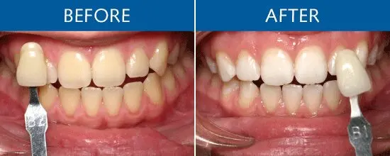 Teeth whiteness as a marker of success