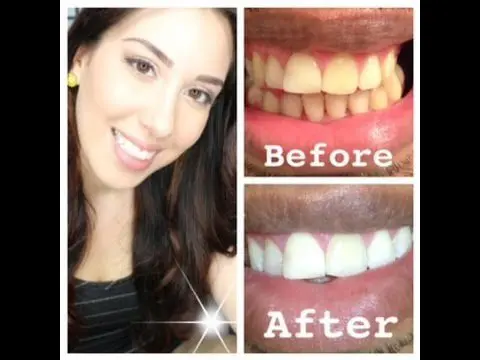 Teeth whitening at home: video reviews