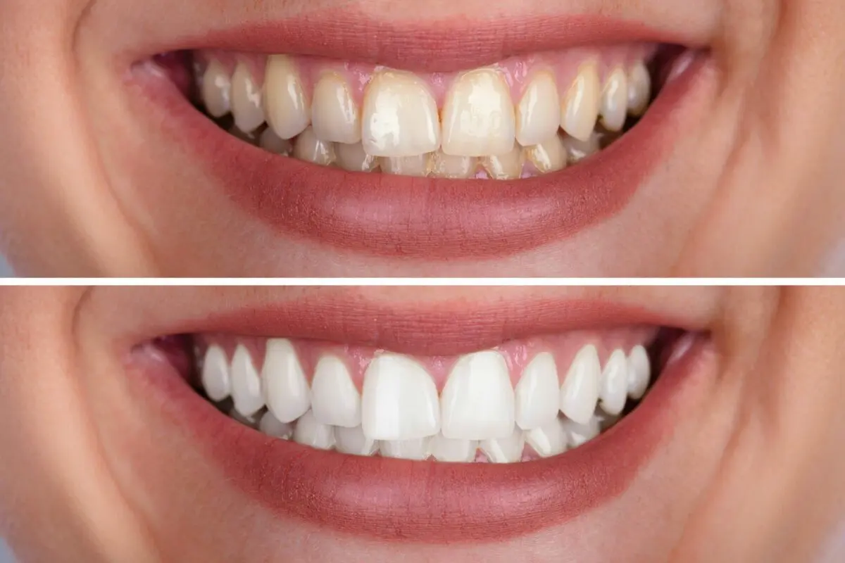 Teeth whitening: dentists against