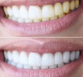 Teeth whitening: indications, effectiveness, price