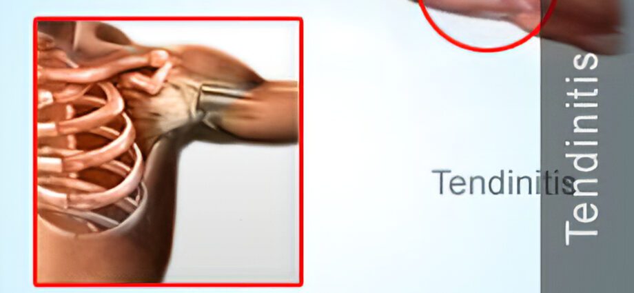 Tendinitis: complementary approaches