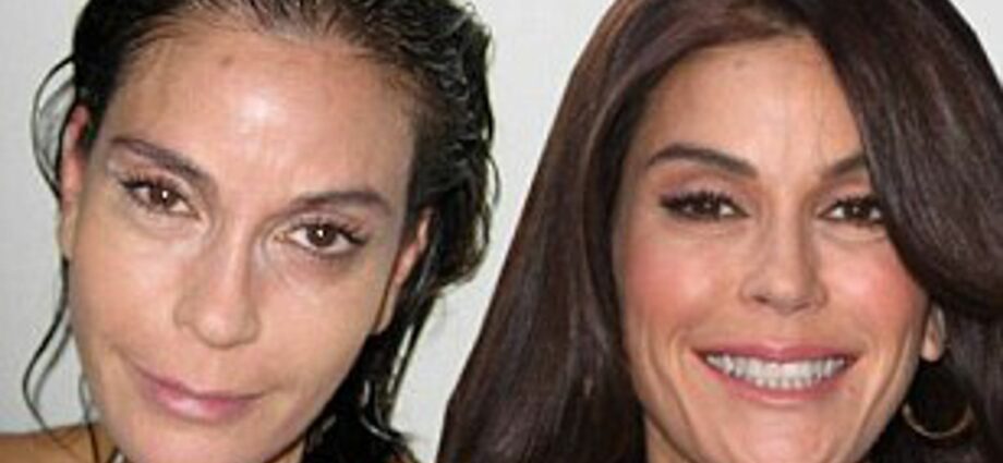 Teri Hatcher after Botox injection. Photo