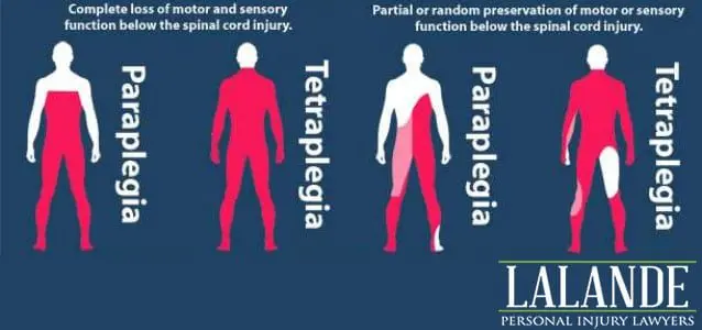 Tetraplegia